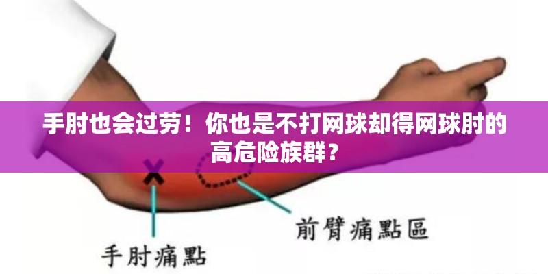 手肘也会过劳!你也是不打网球却得网球肘的高危险族群? 手肘也会过劳!你也是不打网球却得网球肘的高危险族群?